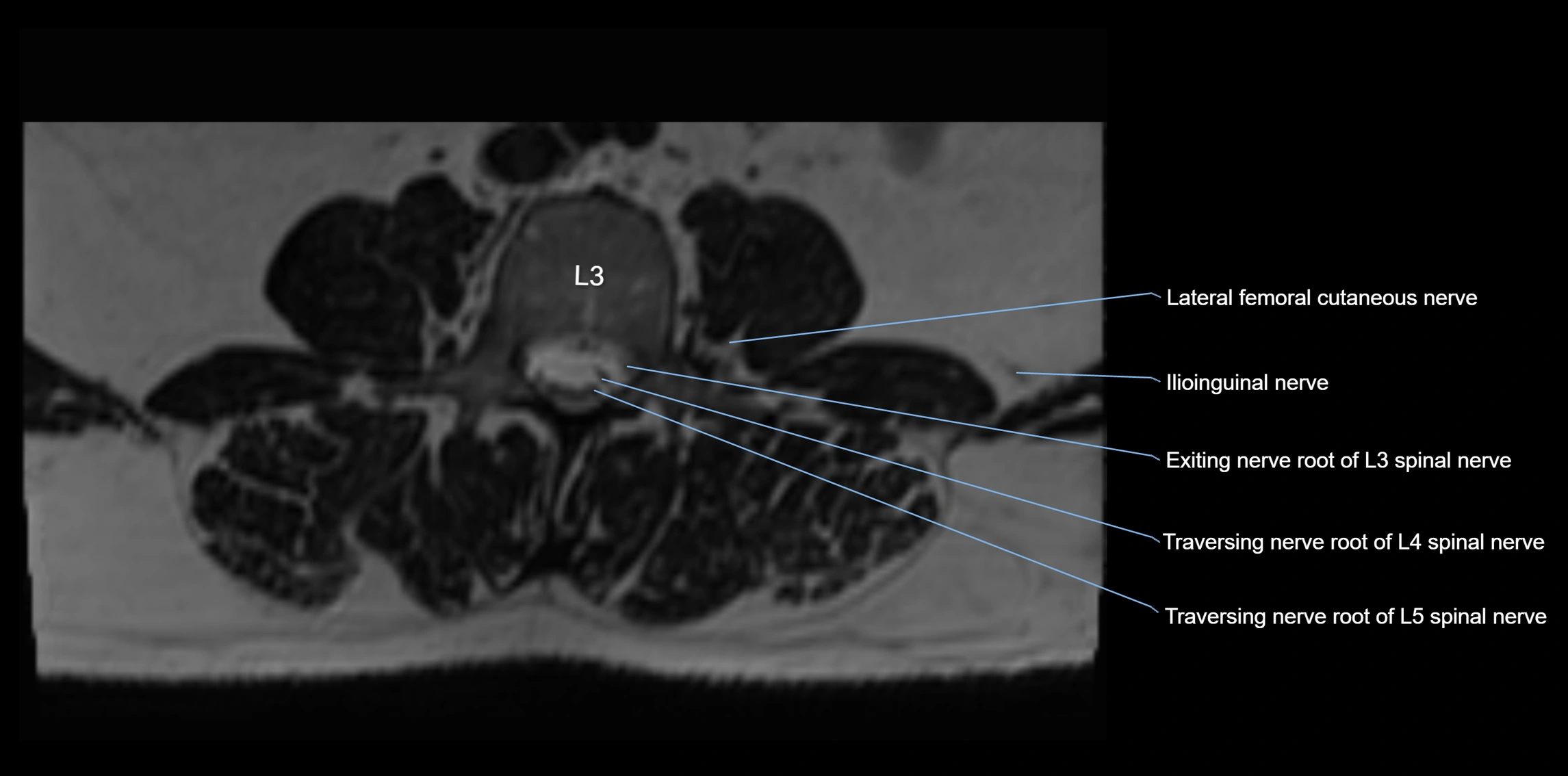 MR lumbosacral plexus axial cross sectional anatomy 3T  radiology  image-img-1008001-00021.webp